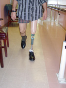 Ambulation exhibited with excellent balance and control on affected limb. Multiaxial foot. - Garrison's Prosthetic Services