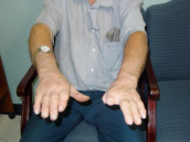 Missing digits at high levels. - Garrison's Prosthetic Services